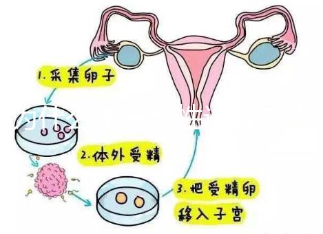 為什么單身女性選擇烏克蘭MINI醫(yī)院試管嬰兒？詳細分析三個原因