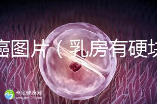 乳癌圖片(乳房有硬塊的位置圖片)