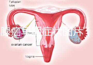 乳腺癌早期癥狀圖片(初期人乳頭瘤圖片)