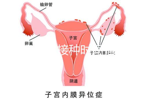 麻疹疫苗接種時間指南，初種年齡最好不要晚于這個月齡